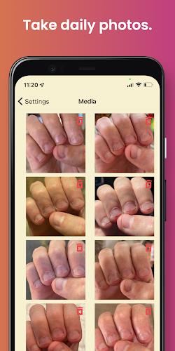 NailKeeper - Stop Biting Nails  Screenshot 1