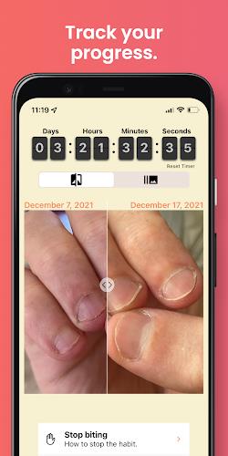 NailKeeper - Stop Biting Nails  Screenshot 3